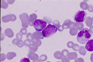 CITOLOGIA GINECOLÓGICA E ONCO HEMATOLOGIA