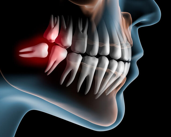 CIRURGIA ORAL MENOR 